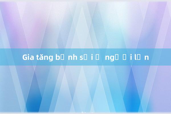 Gia tăng bệnh sởi ở người lớn